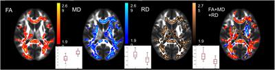 Evidence for Plastic Processes in Migraine with Aura: A Diffusion Weighted MRI Study